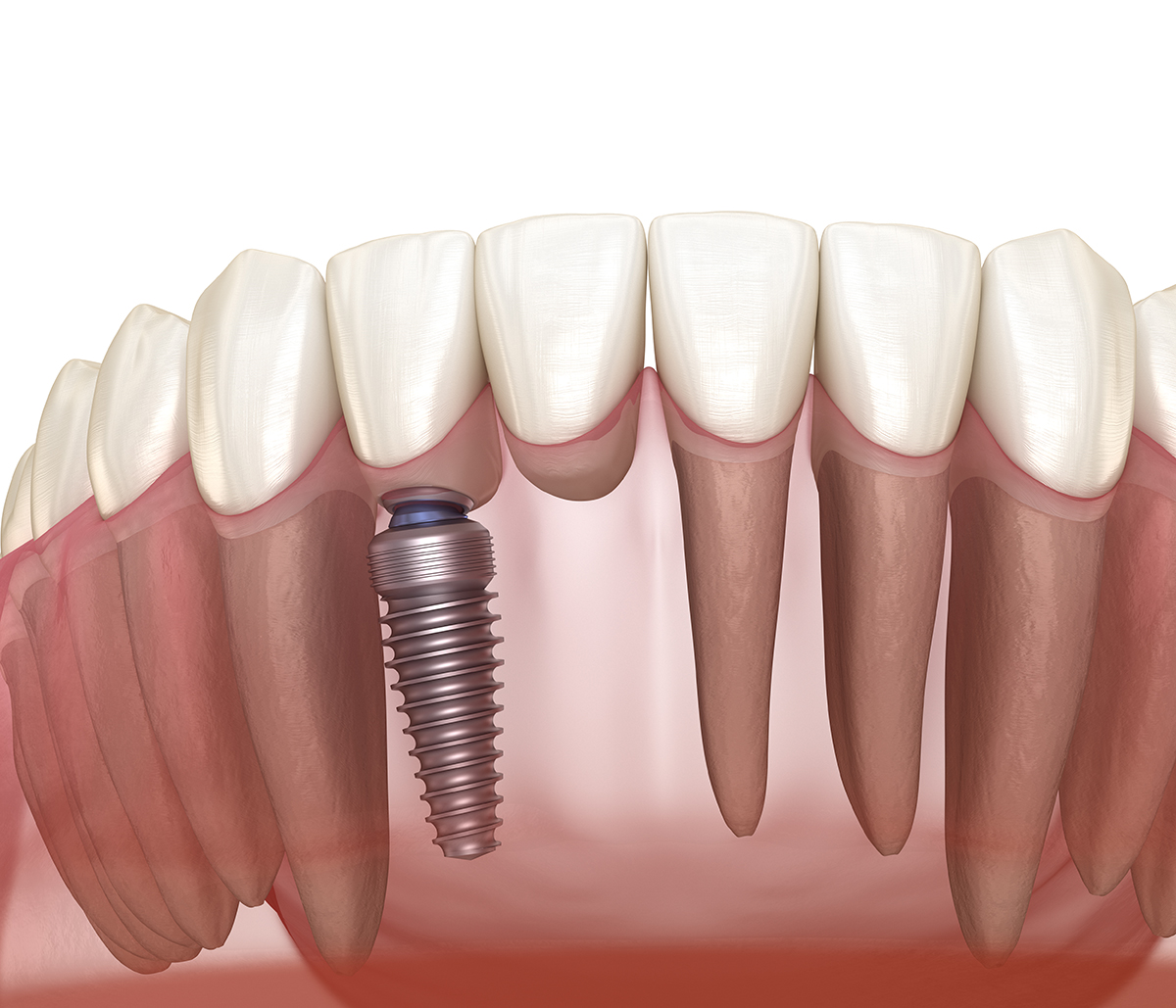 Dental Implant, Dental Implants Kirkland