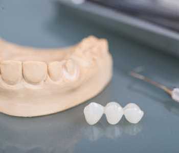 Tooth Replacement Kirkland - Image Of Dental Crowns