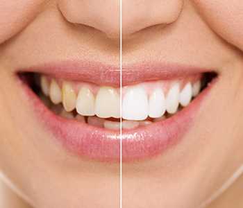 Teeth whitening image for Kingsgate Dental