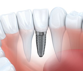Multiple ways to replace teeth with dental implants
