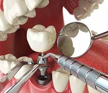 Dr. Ann Kelley at Kingsgate Dental explains why get dental implants to patients in Kirkland, WA area
