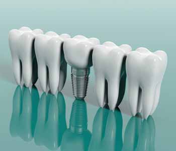 Dental implants are a permanent tooth replacement option. Contact Dr. Ann Kelley and the staff at Kingsgate Dental Clinic in Kirkland,