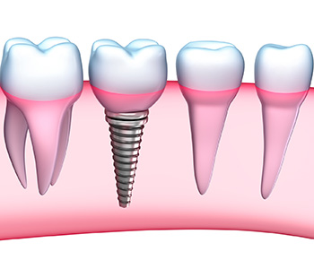 Dental Implants Procedure in Kirkland area