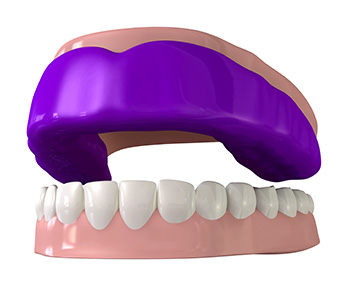 Protect Teeth with Good Quality Mouthguards Available in Kirkland Wa Area