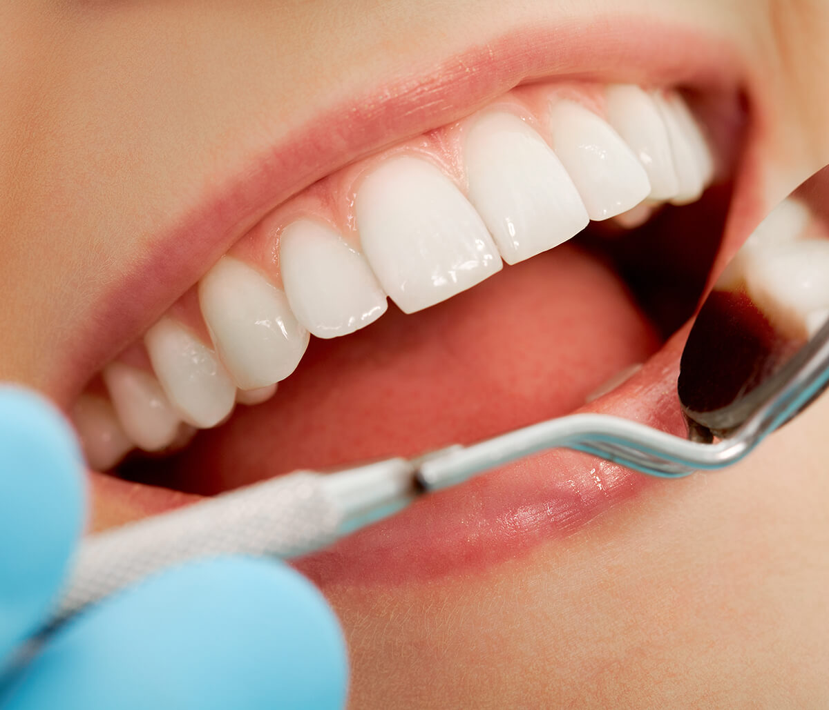 In Kirkland, WA Area, Dentist Offers Professional Teeth Whitening Services