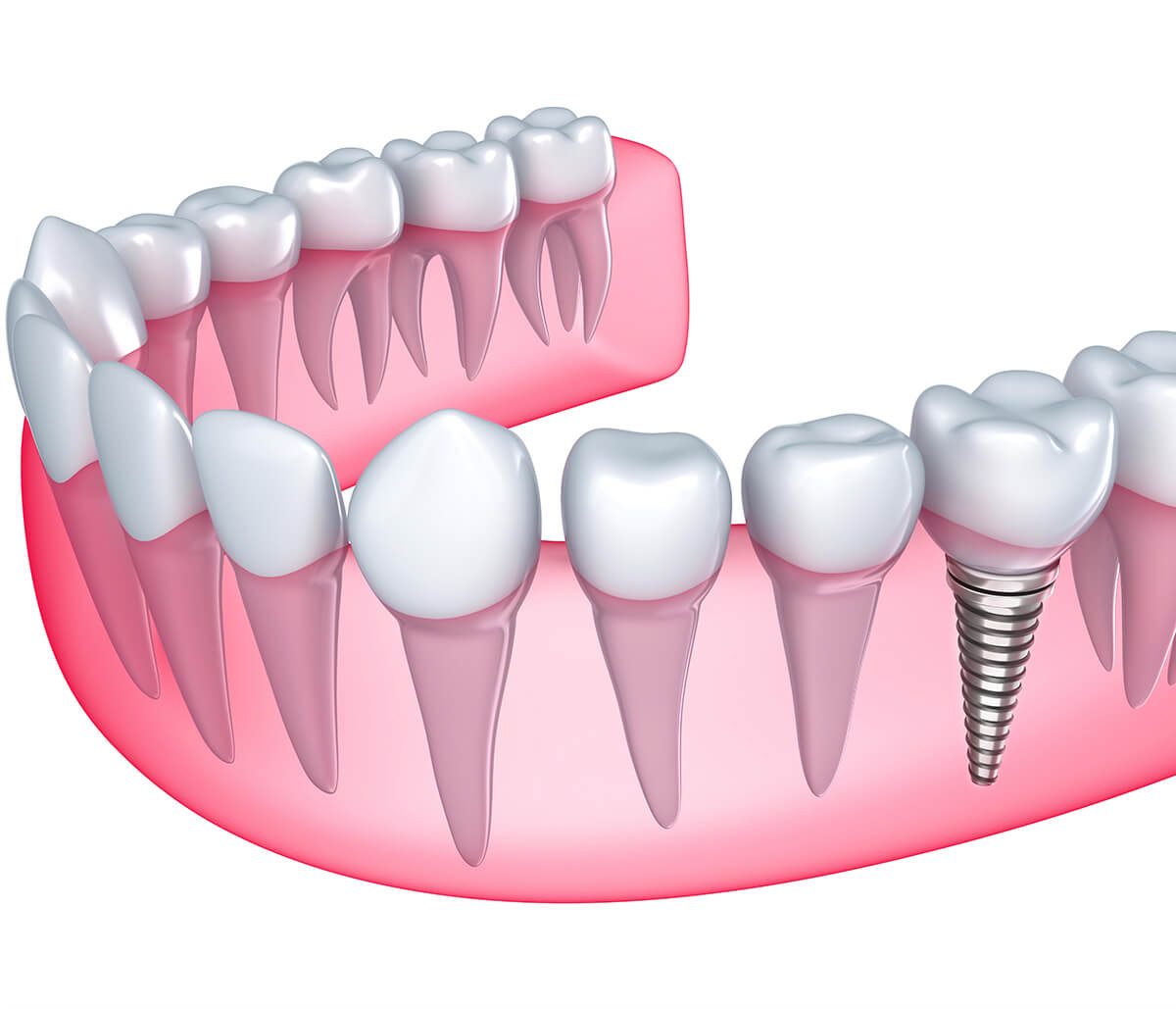 Dentist Describes Replacing Missing Teeth with Dental Implants in Kirkland, WA Area