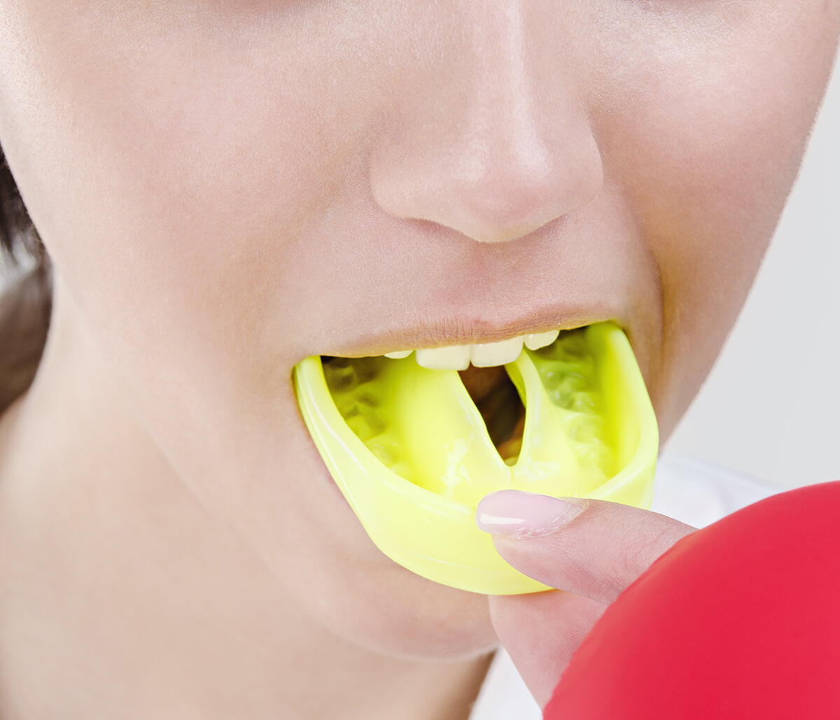 Find Professionally Fitted Dental Mouthguards for Sports in Kirkland Area
