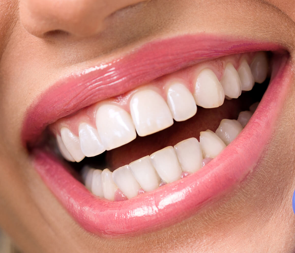 Benefits of a Professional Teeth Whitening Treatment with a Dentist in Kirkland Area