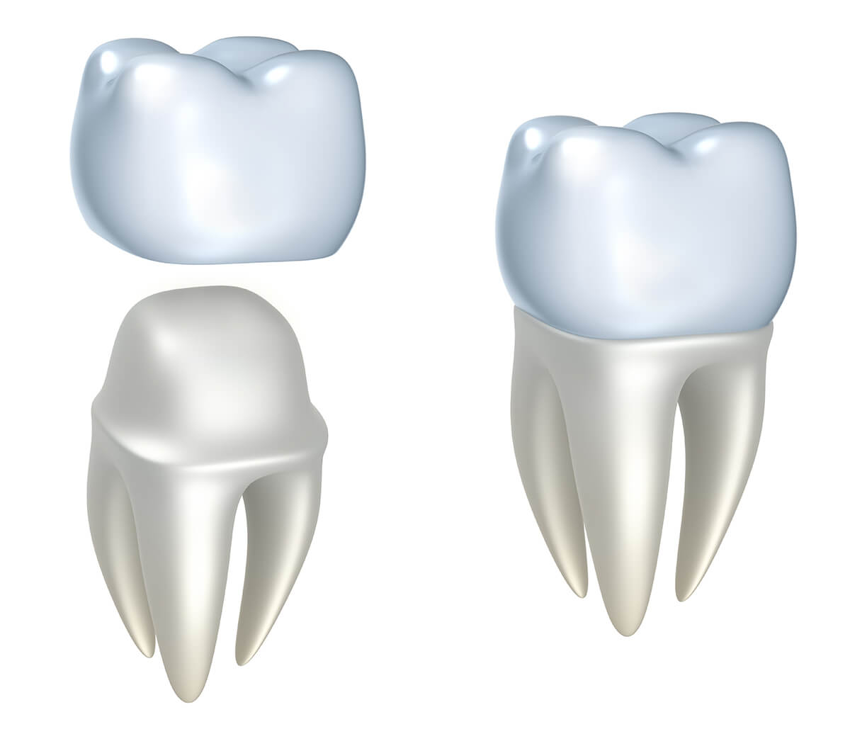 Dental Crown Replacement in Kirkland WA Area