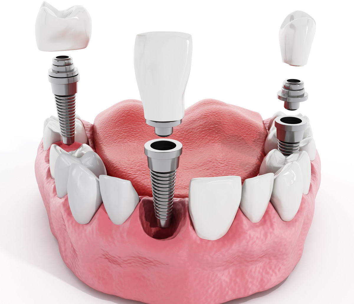 Top Reasons To Get Teeth Implants Near Me In Kirkland WA Area