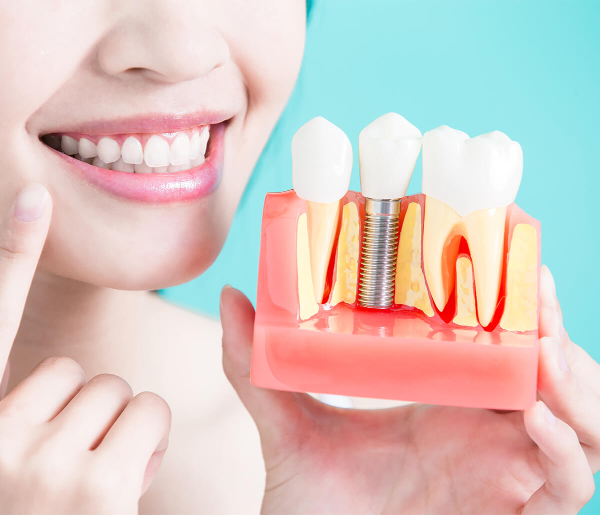 Teeth Implants Dentist in Kirkland WA Area