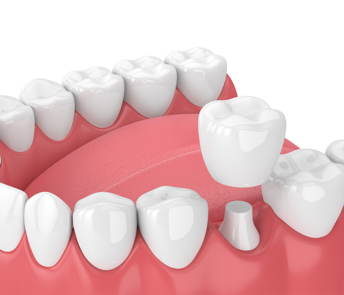 After the Dental Crown Procedure, Your Damaged Teeth Will Look and Feel Strong and Healthy in Kirkland Area