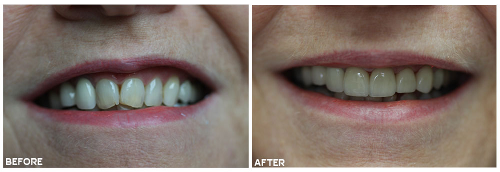 Kingsgate Dental Front Anterior Crowns Before and After Results