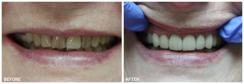 Kingsgate Dental Before and After Results Front Anterior Crowns