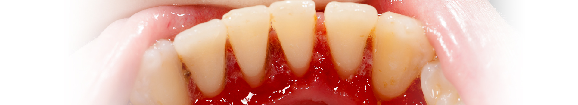 Gum Disease Treatments in Kirkland, WA