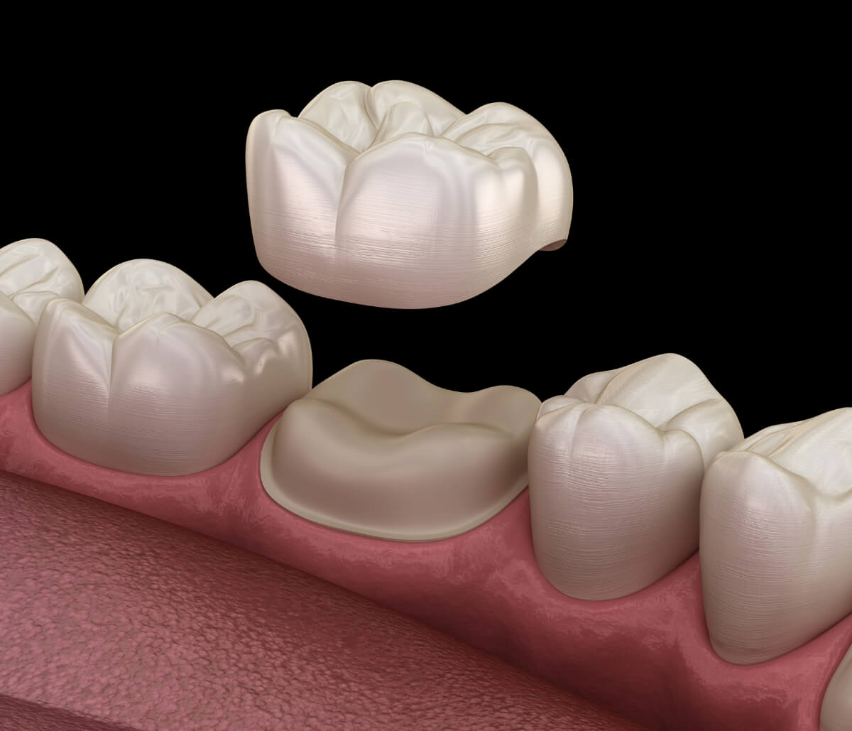 Dental Crowns on Front Teeth in Kirkland WA area
